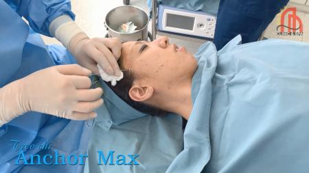 Căng da mặt - Trẻ hóa da với phương pháp  treo chỉ Anchor Max